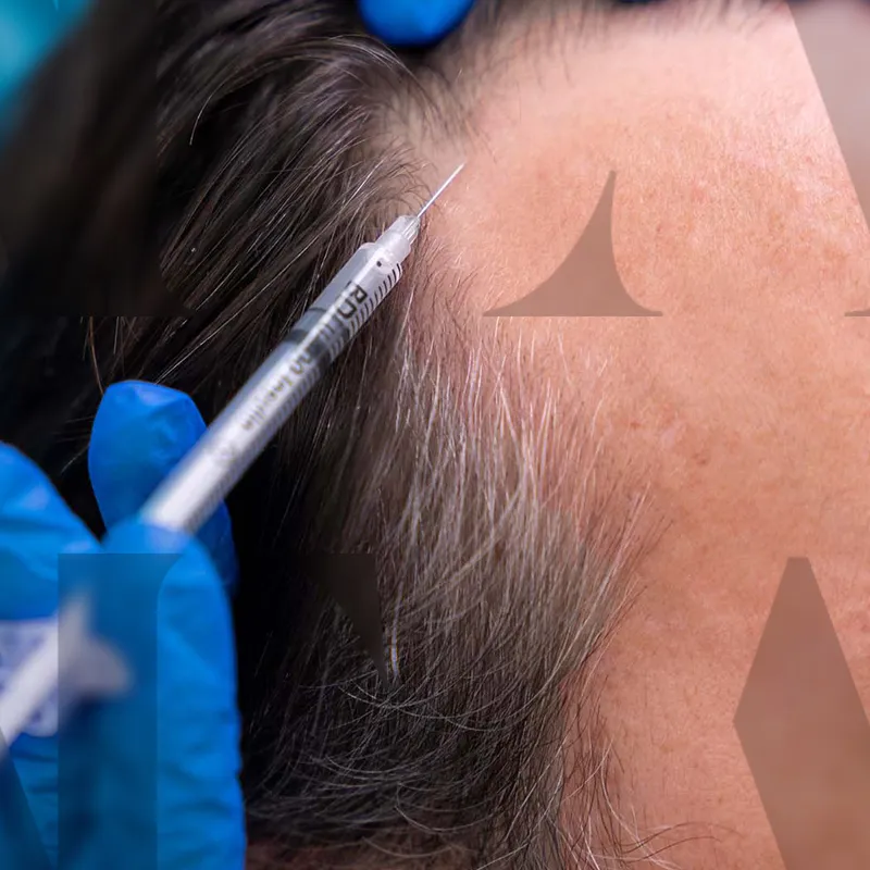 مزوتراپی مو چیست و چه مزایا و کاربردهایی دارد؟ مزوتراپی مو